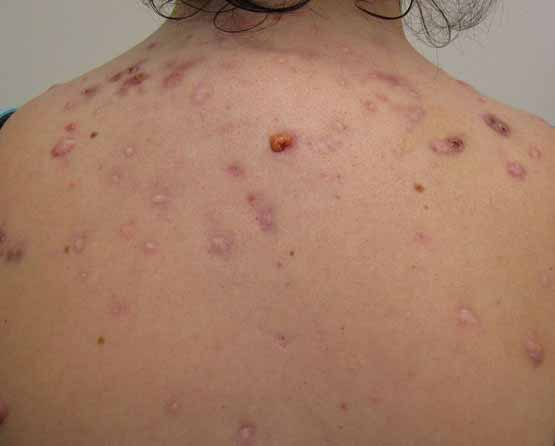 acne op rug